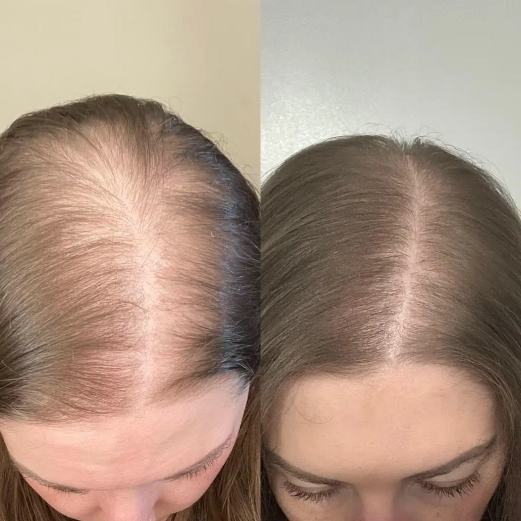 Жена преди и след: челна линия, по-рядка и после по-плътна